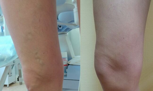 jalg enne ja pärast retikulaarsete veenilaiendite ravi