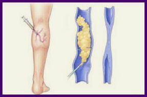 Skleroteraapia on populaarne meetod jalgade veenilaiendite vabanemiseks